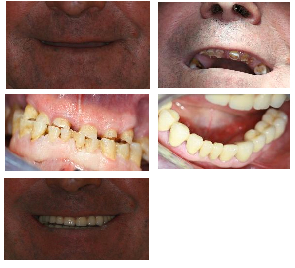 Rehabilitación de dientes desgastados